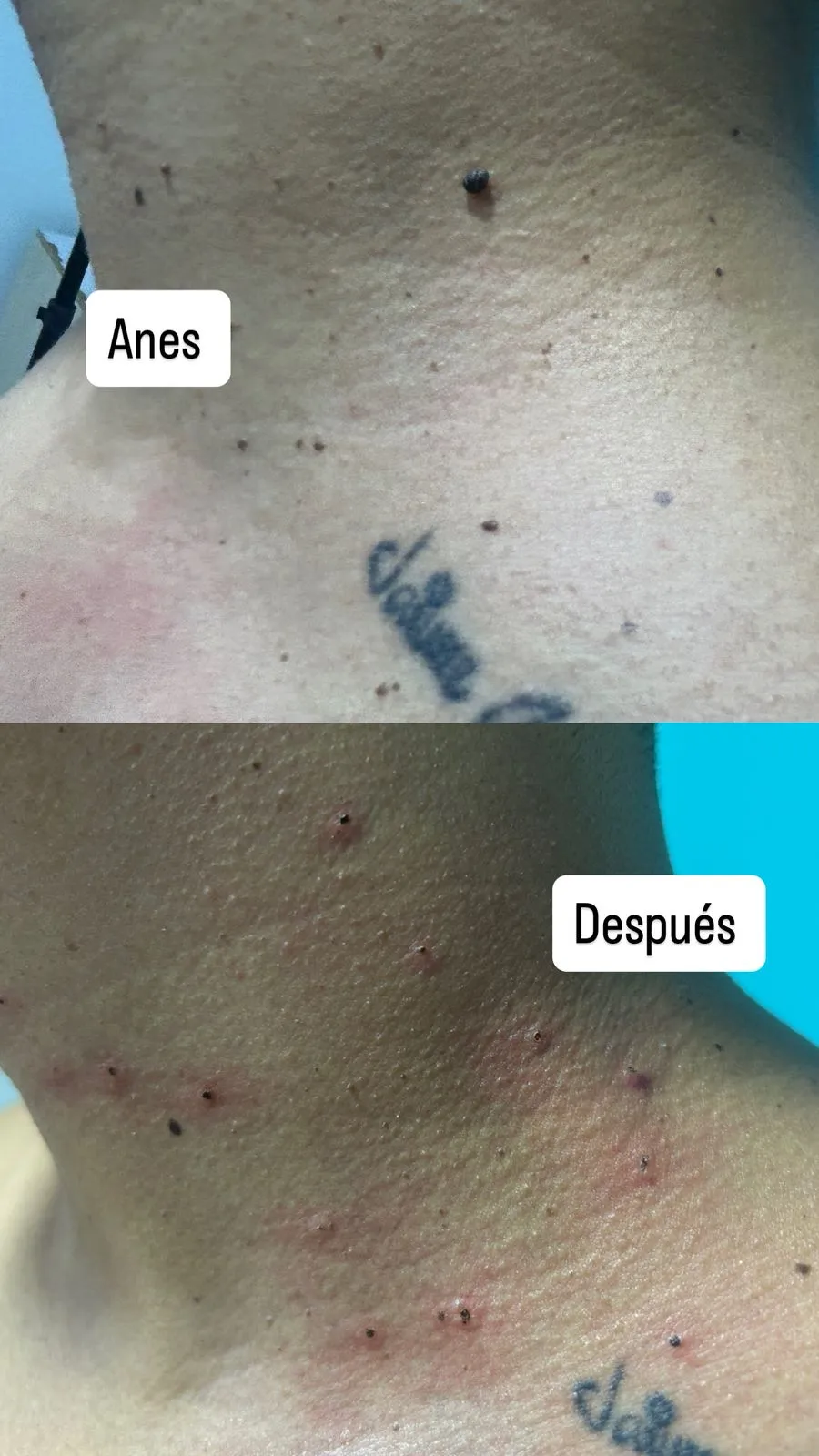 casos_cauterizacion2