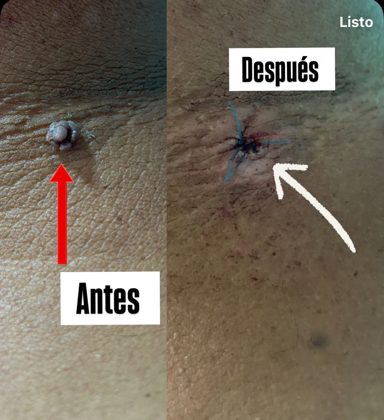 casos_cauterizacion3