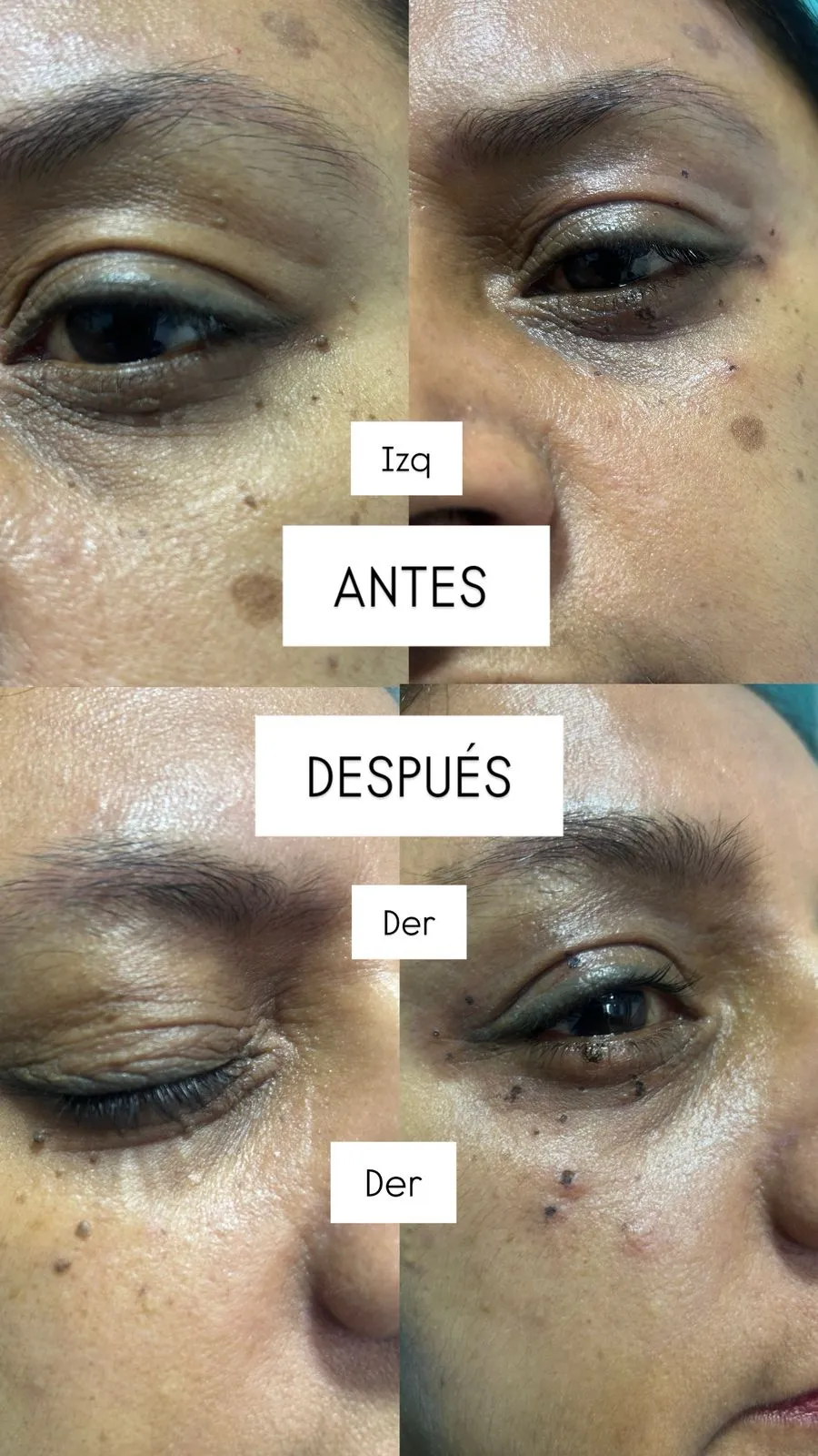 casos_cauterizacion4