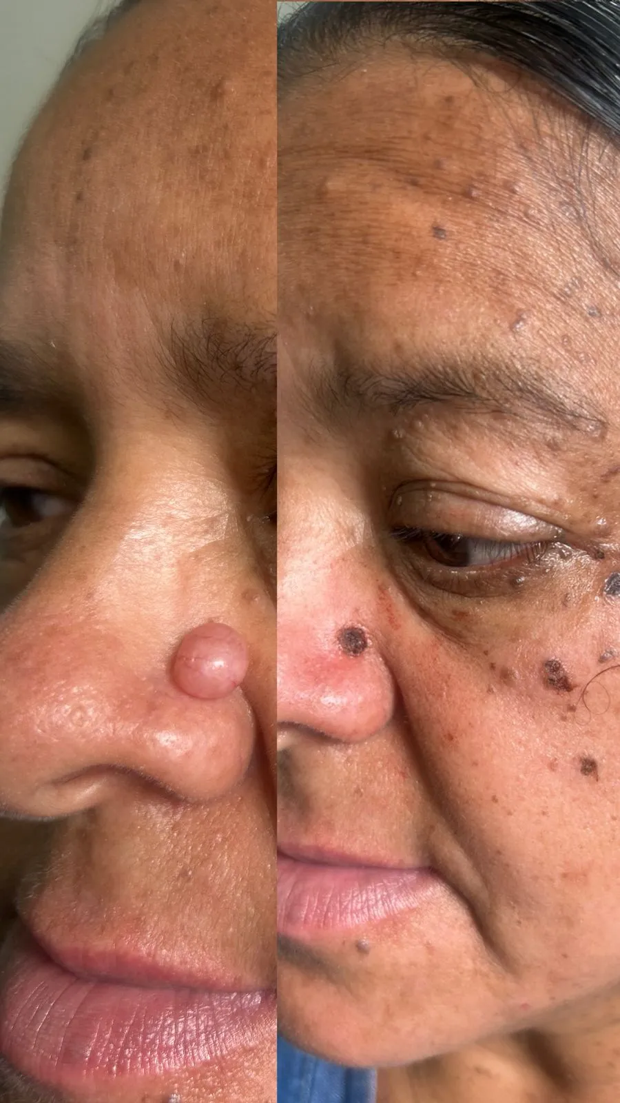 casos_cauterizacion7