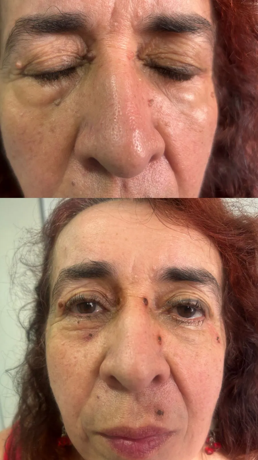 casos_cauterizacionB