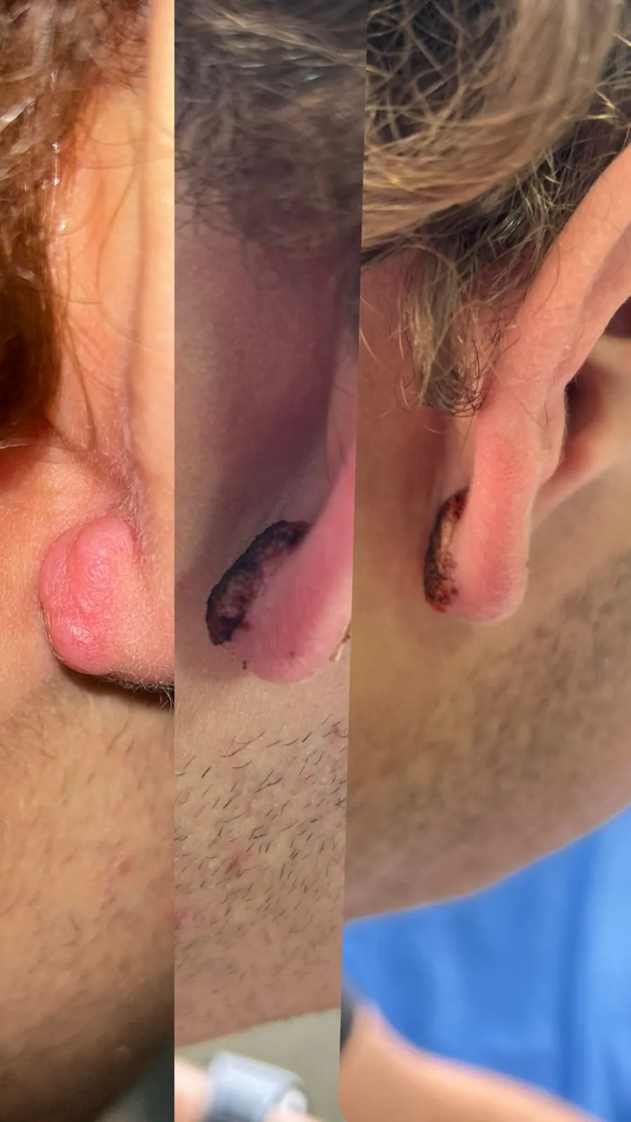 casos_cauterizacionC