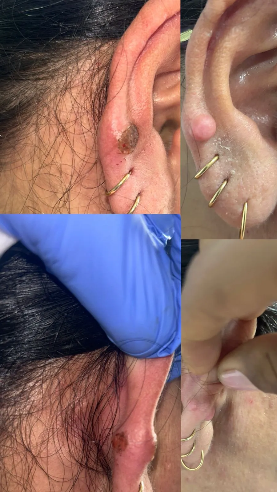 casos_cauterizacionD