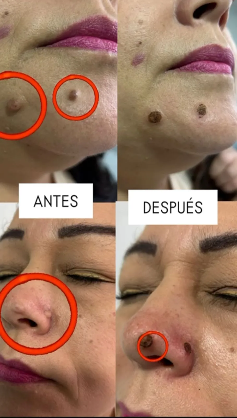 casos_cauterizacionF